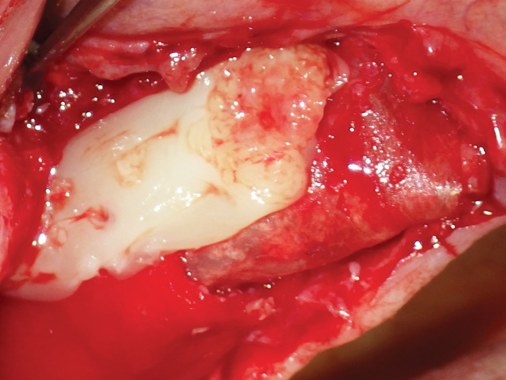 Platelet-rich fibrin growth over barrier membrane
