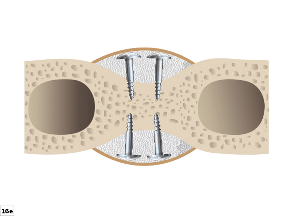 buccal-lingual defect illustration