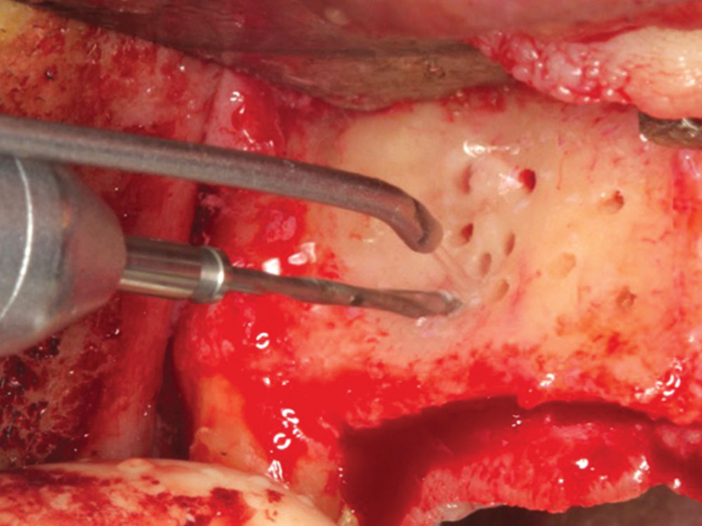 Decortication holes with a cross-cut fissure bur