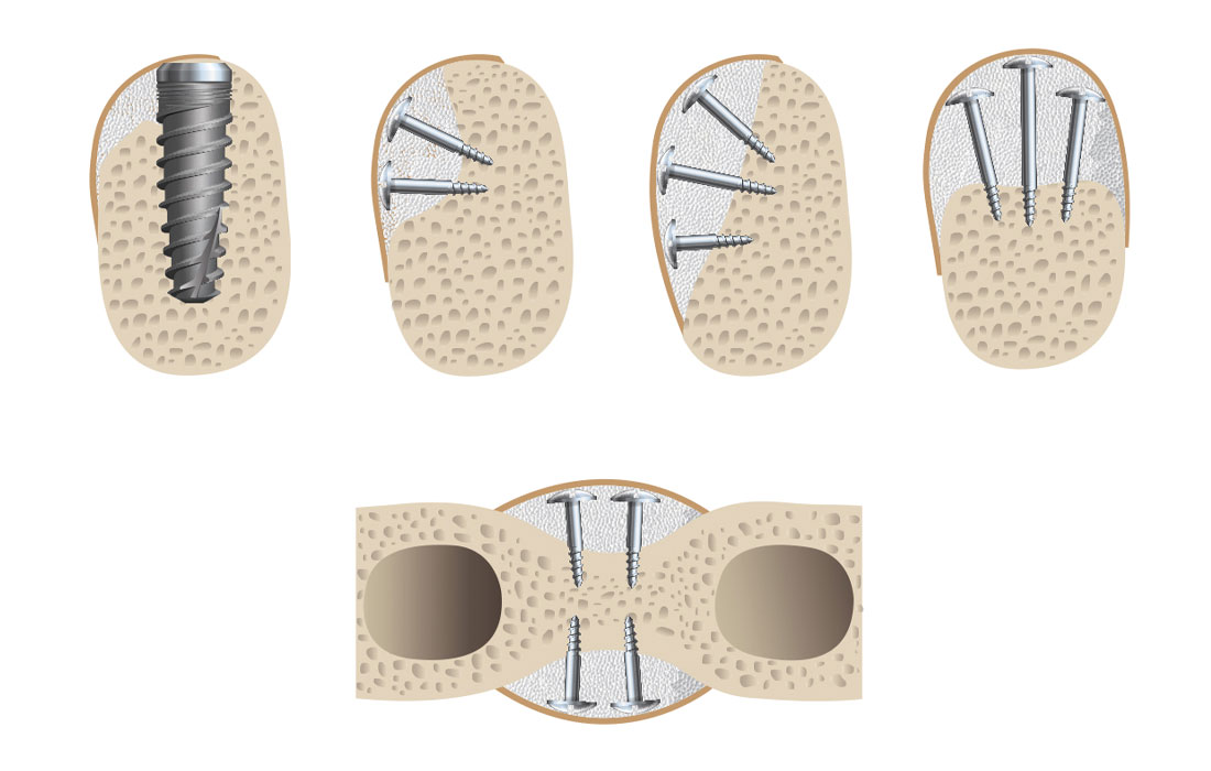 Ridge Augmentation CSM V15I2 Cover Image