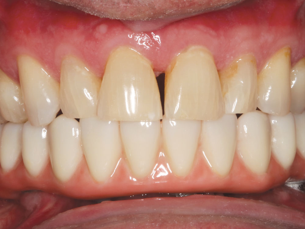 BruxZir Implant Prosthesis