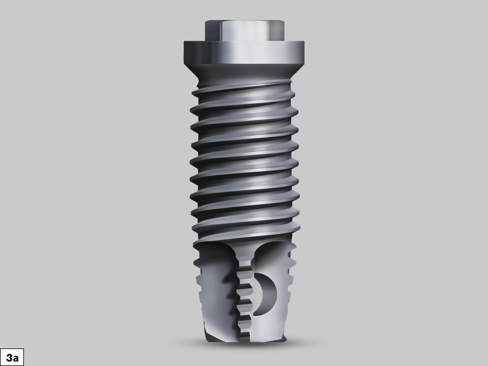 Threaded implant