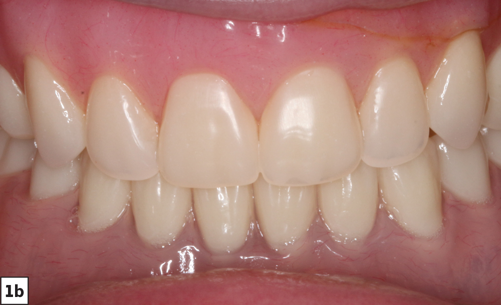 Figure 1b - patient smile before overdentures - V15I2