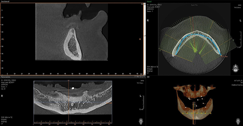 Figure 3- CBCT Analysis - V15I2