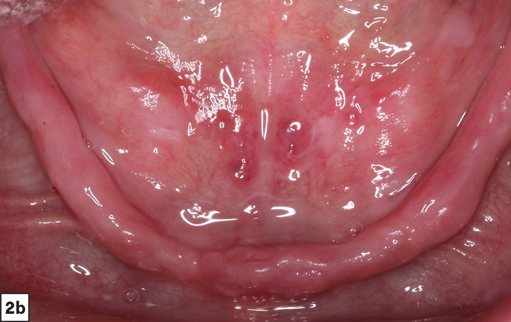 Figure 2b - bone loss in edentulous ridges - V15I2