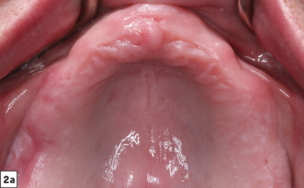 Figure 2a - Edentulous ridges and mandibular bone loss - V15I2