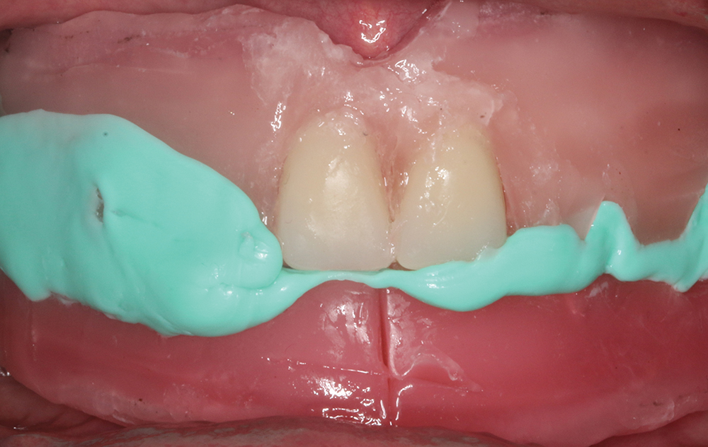 Figure 6 - Wac rim production - V15I2