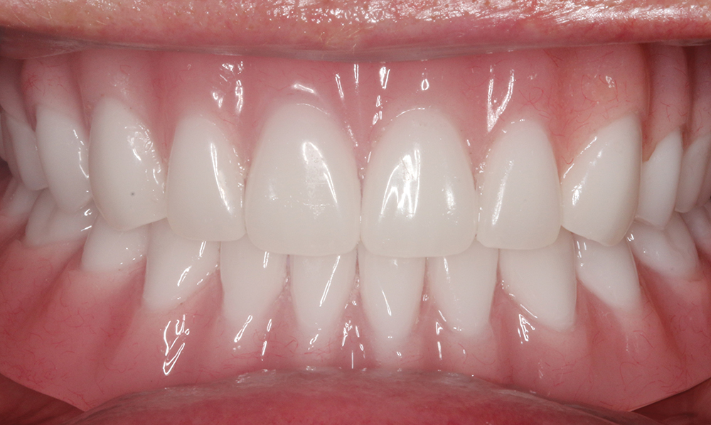Figure 10 - Patient smile with final locator overdentures - V15I2