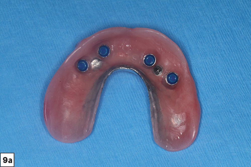Figure 9 - Final locator overdentures - V15I2