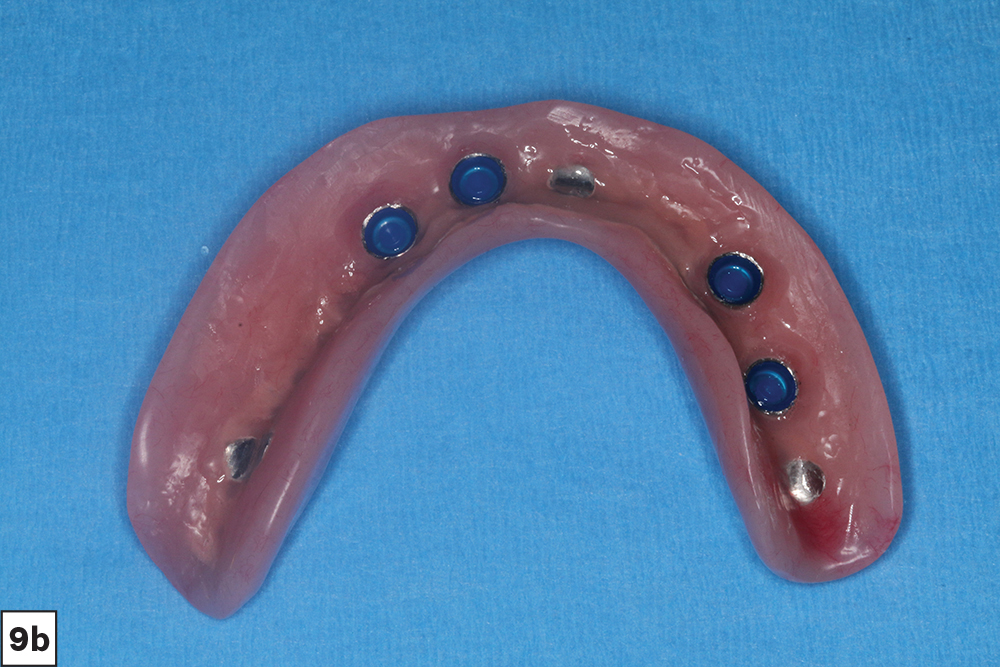 Figure 9b - Final locator overdentures - V15I2