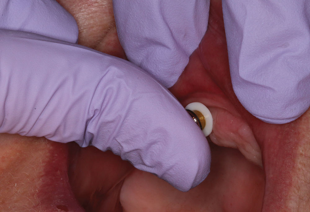 Step 2 - Snap locator housings