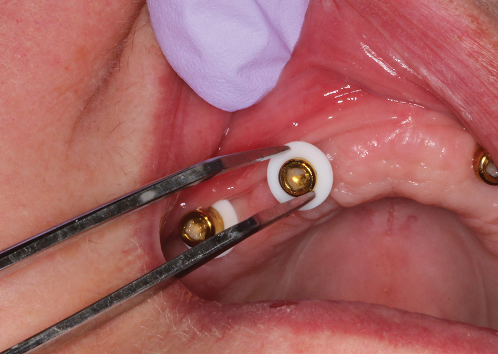 Step 1 - Place white blockout spacer over abutment