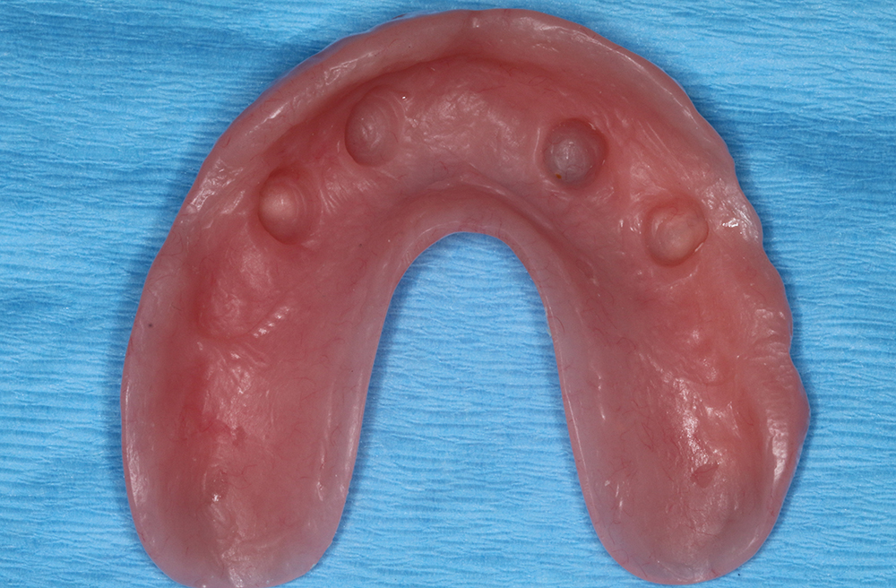 Step 4 - Seat overdenture over locator housings