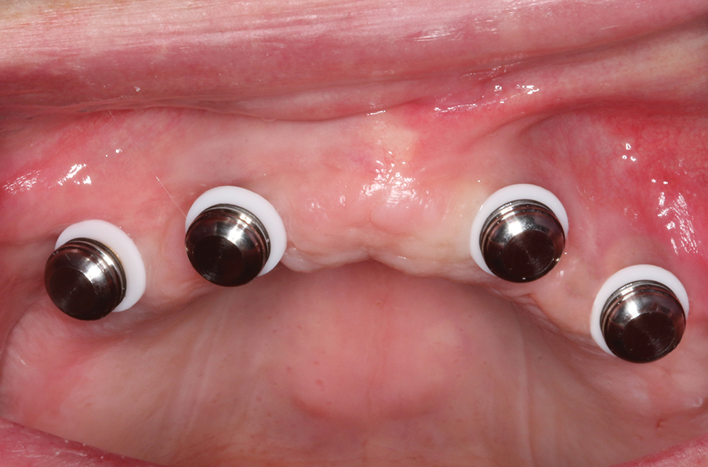 Step 3 - Seat metal housings