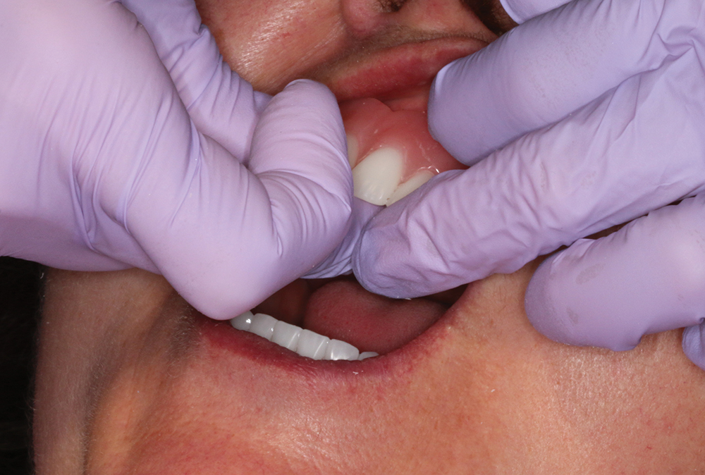 Step 6 - Seat the denture onto the tissue