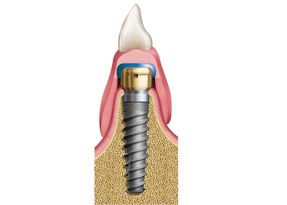 Locator Overdenture Illustration - V15I2