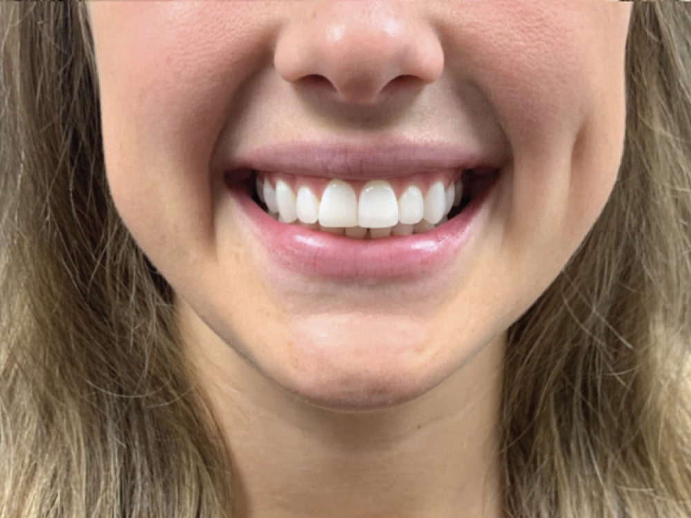 After Botox CSM V16I1 Interview Dr. Sheehan