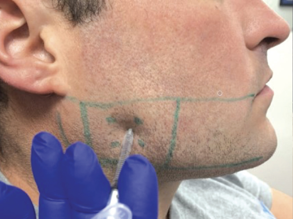 Dr. Sheehan Botox Injection CSMV16I1 Interview