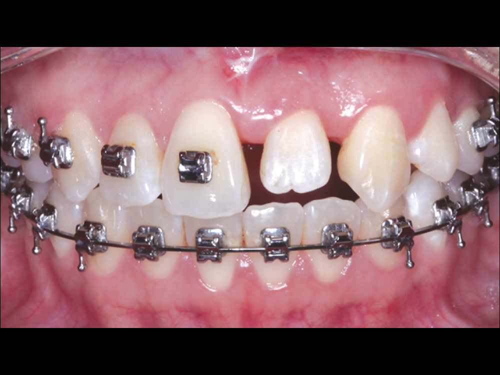 Figure 3 CSM V16I1 A Multidisciplinary Approach for the Best Esthetics
