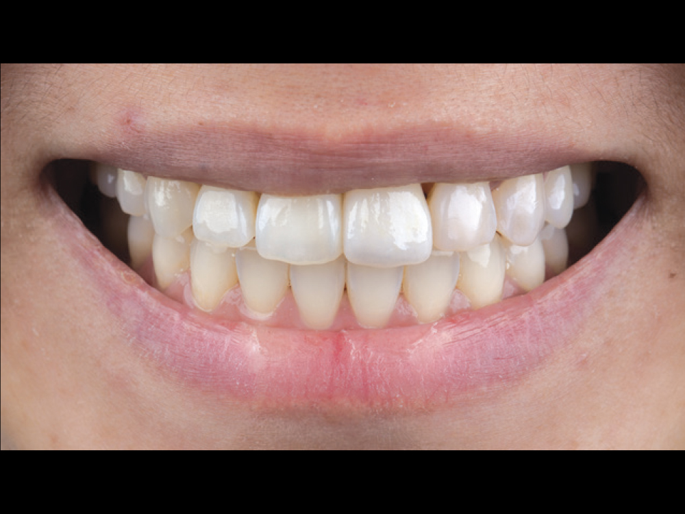 Figure 10 CSM V16I1 A Multidisciplinary Approach for the Best Esthetics