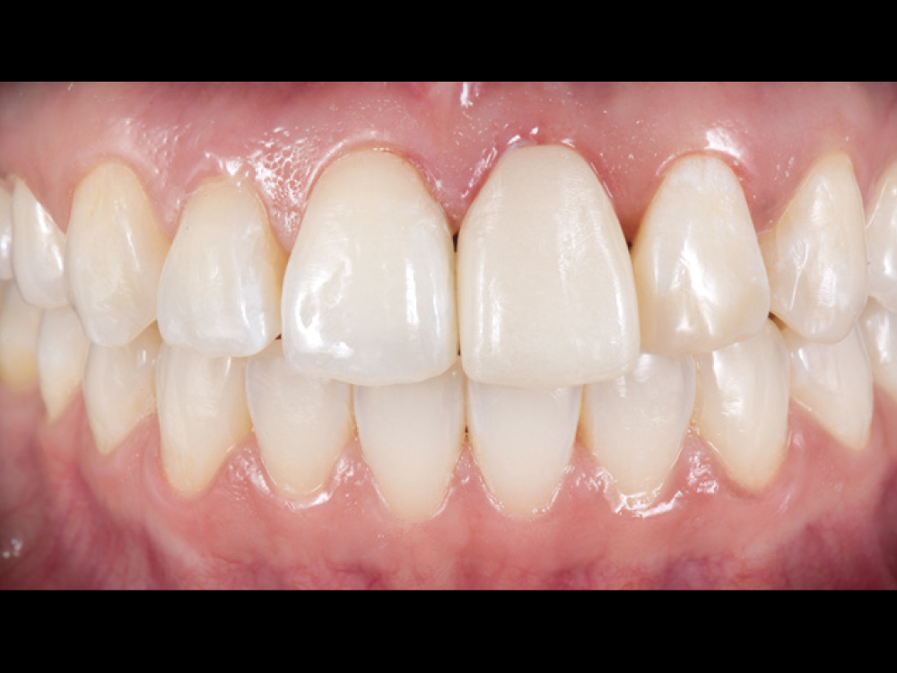 Figure 8 CSM V16I1 A Multidisciplinary Approach for the Best Esthetics