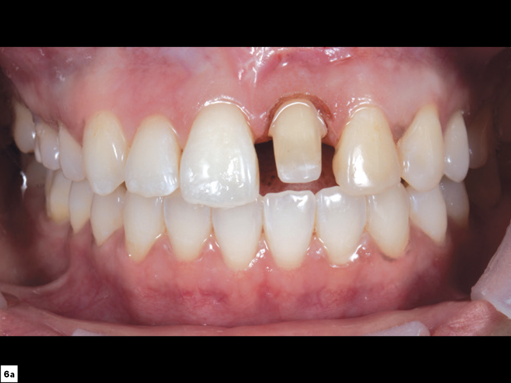 Figure 6A CSM V16I1 A Multidisciplinary Approach for the Best Esthetics