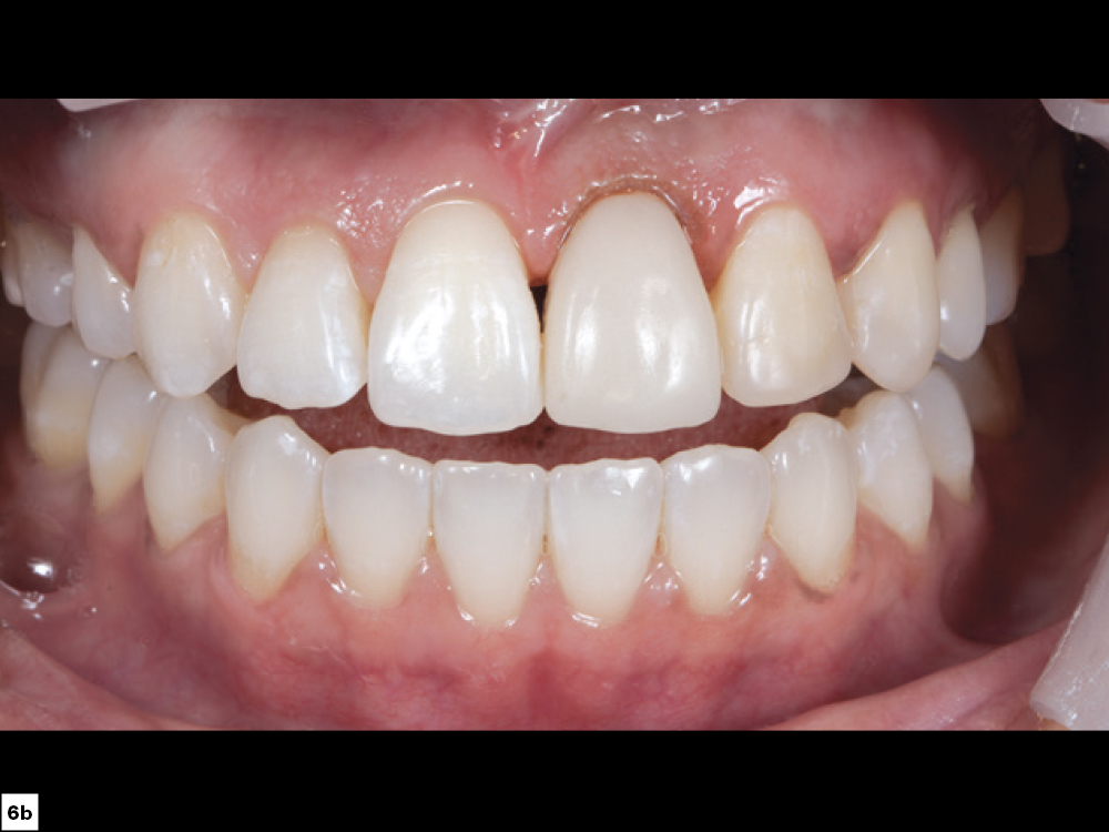 Figure 6B CSM V16I1 A Multidisciplinary Approach for the Best Esthetics