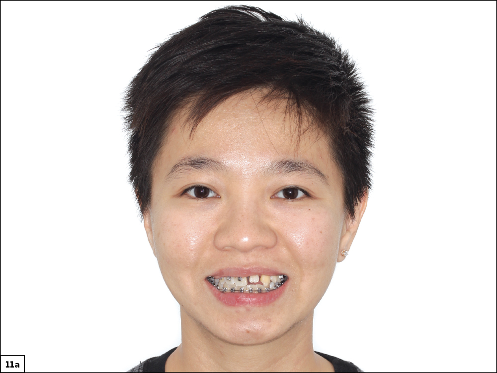 Figure 11A CSM V16I1 A Multidisciplinary Approach for the Best Esthetics