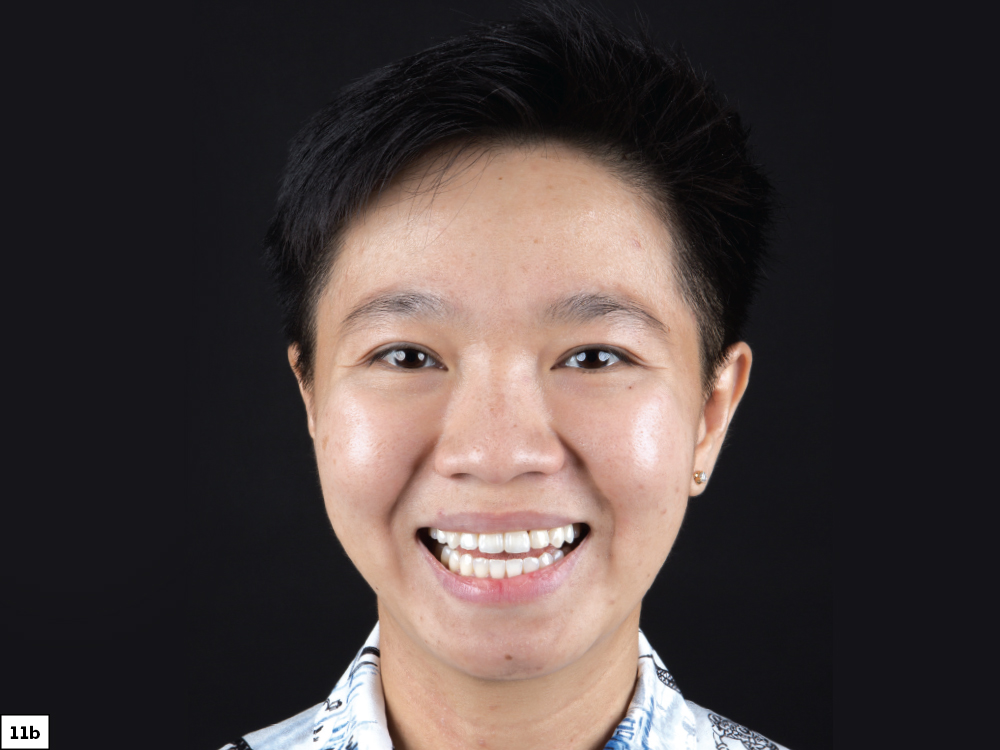 Figure 11B CSM V16I1 A Multidisciplinary Approach for the Best Esthetics