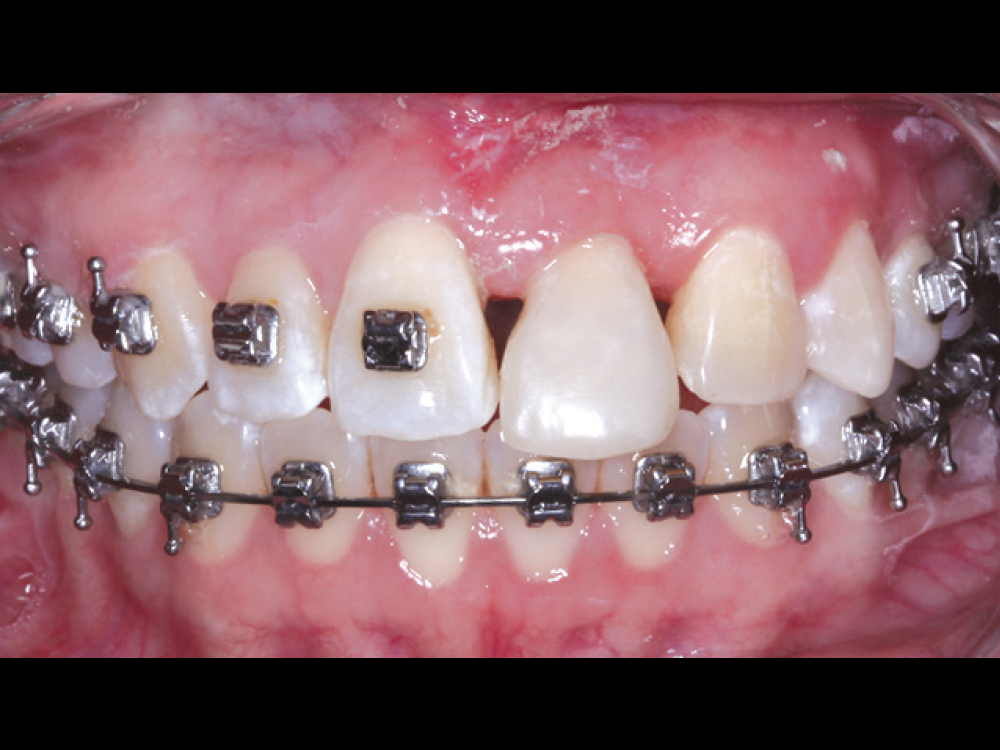 Figure 4 CSM V16I1 A Multidisciplinary Approach for the Best Esthetics