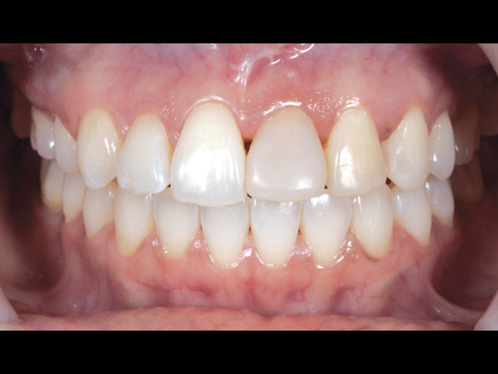 Figure 5 CSM V16I1 A Multidisciplinary Approach for the Best Esthetics