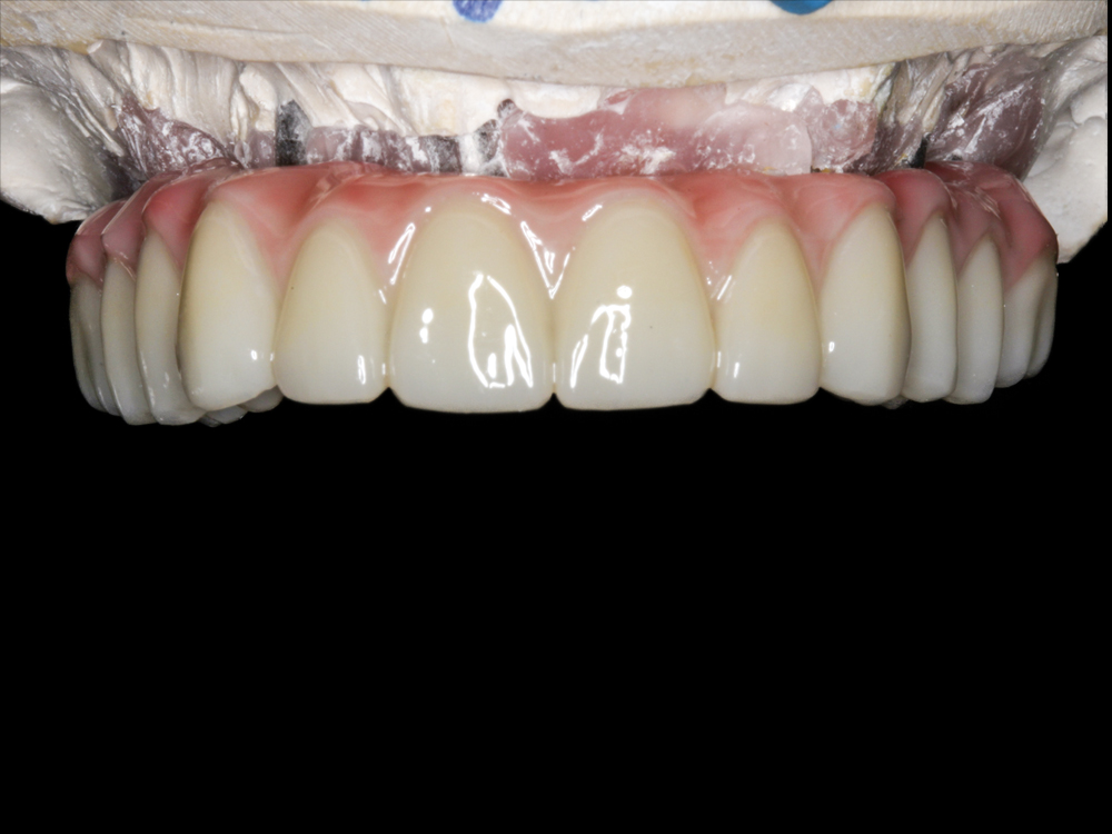 BruxZir Implant Prosthesis