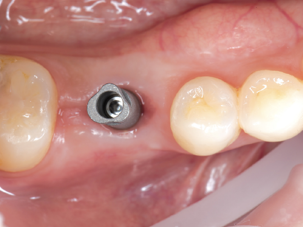Screw in gums Hahn Implant product highlight CSMV16I1