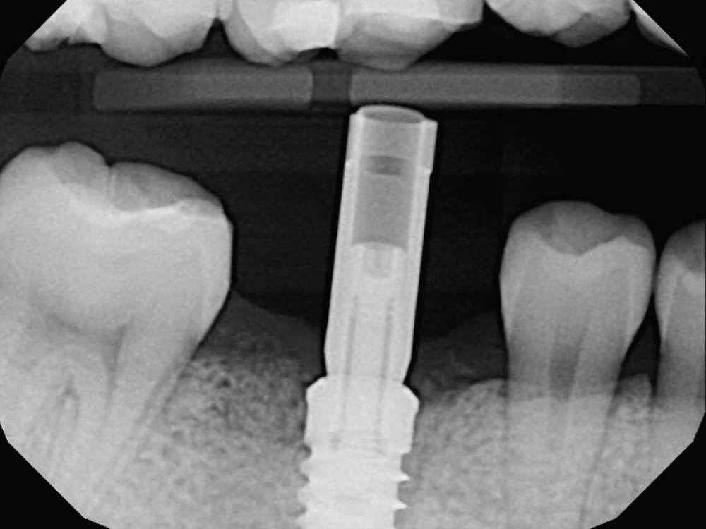 Scan of Hahn Implant Product Highlight CSMV16I1