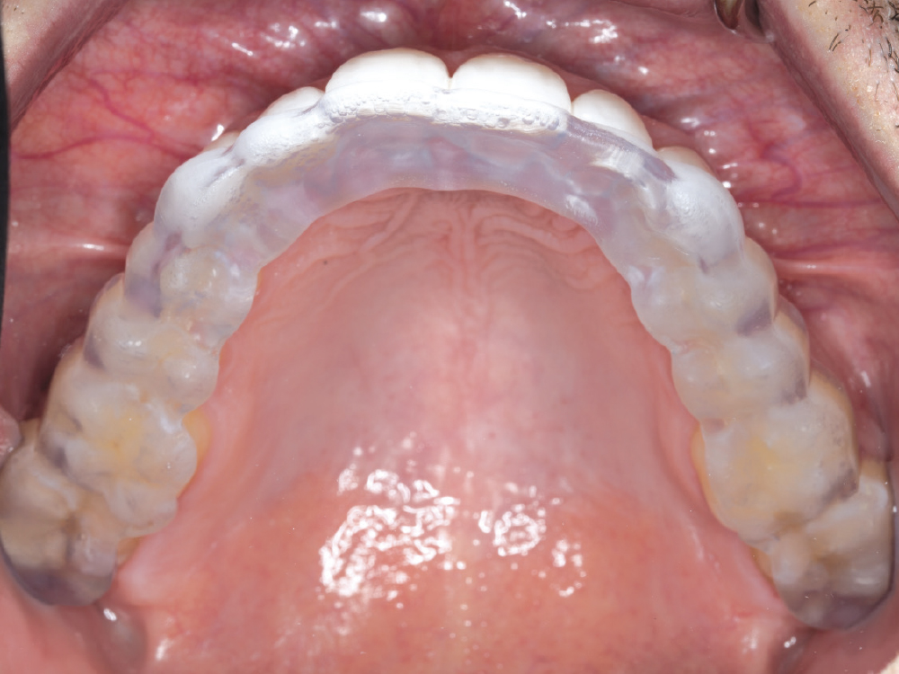 Comfort3D Bite Splint to protect veneers under view of upper arch CSMV16I1