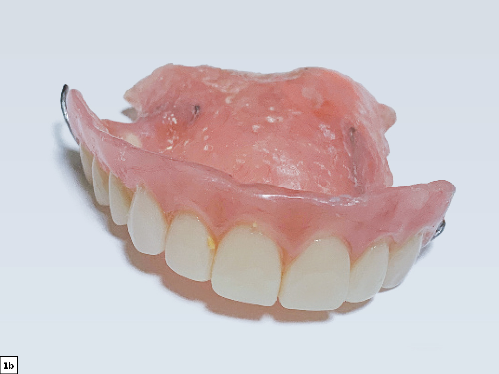 Four added implants to support an FP-3 prosthesis