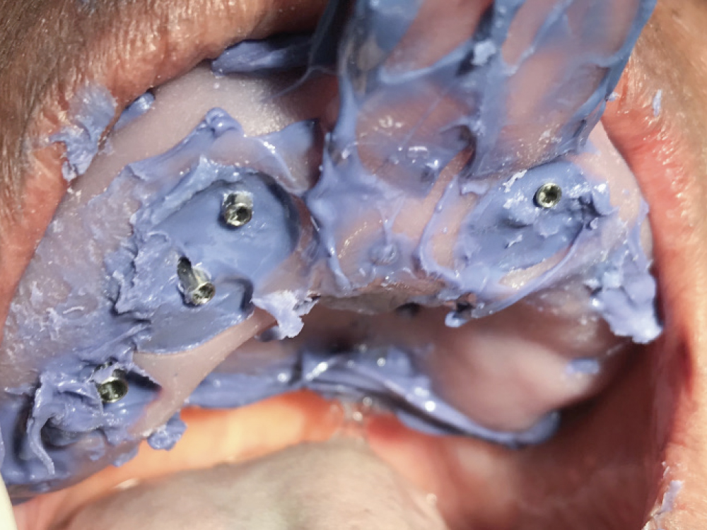 custom tray added for final impression over the IVJ