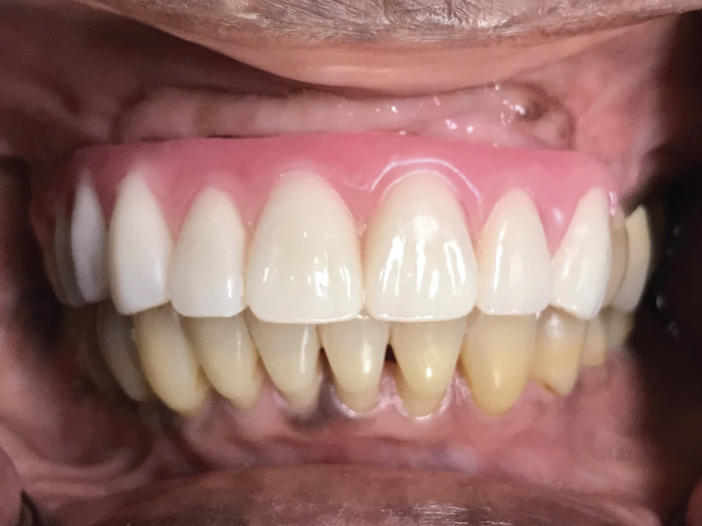 wax setup tried in and evaluated