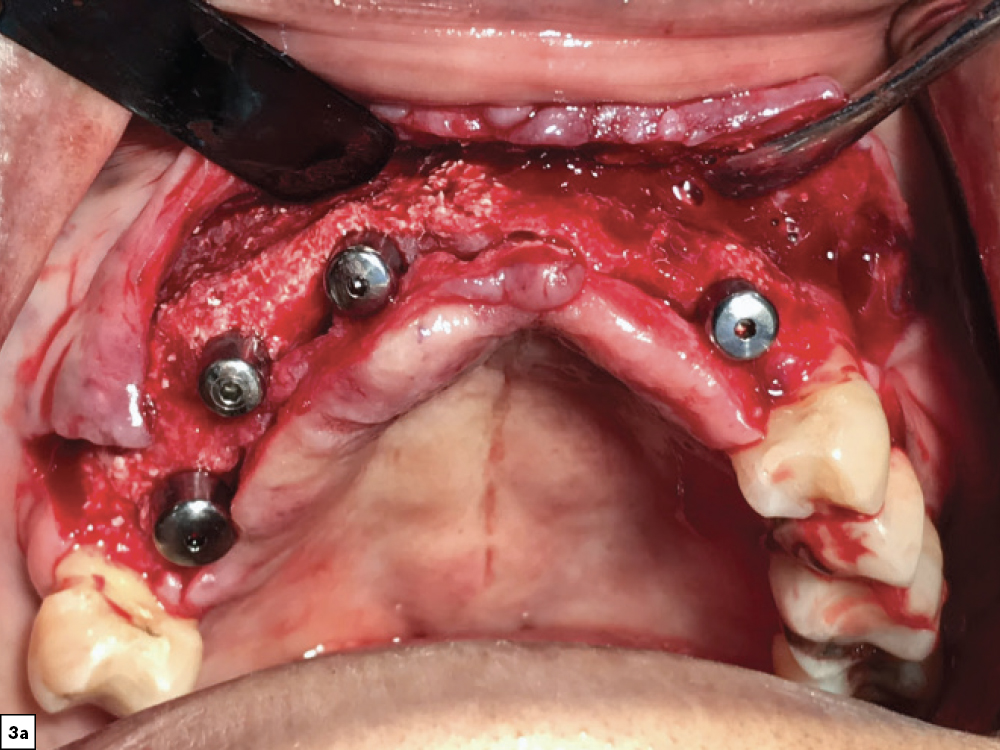 four months of healing after treatment