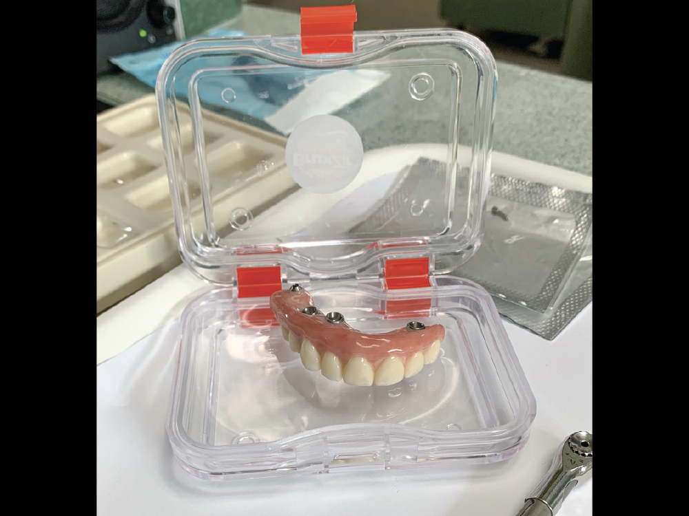 BruxZir Implant Prosthesis on display