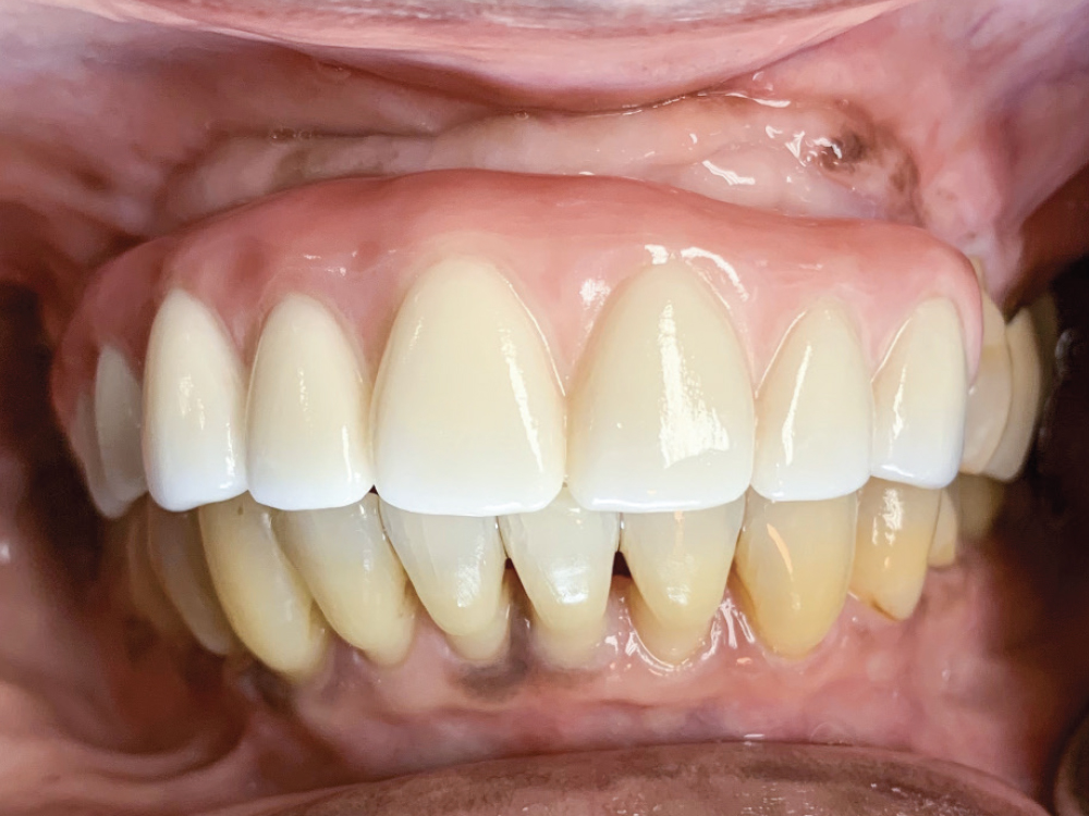 BruxZir Esthetic Partial-Arch Implant Prosthesis