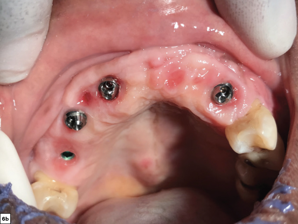 Multi-unit abutments connected to the implants