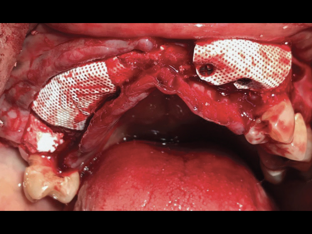 Treatment consisted of guided bone regeneration and alveoplasty