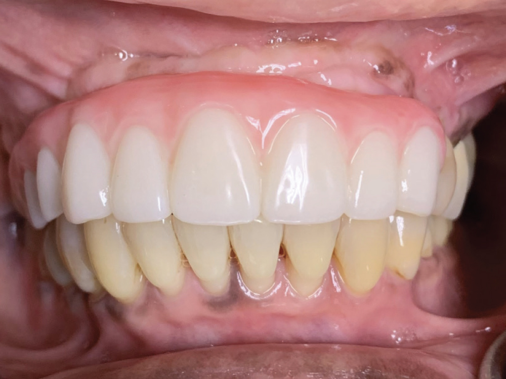 Implant prosthesis designed using CAD/CAM technology