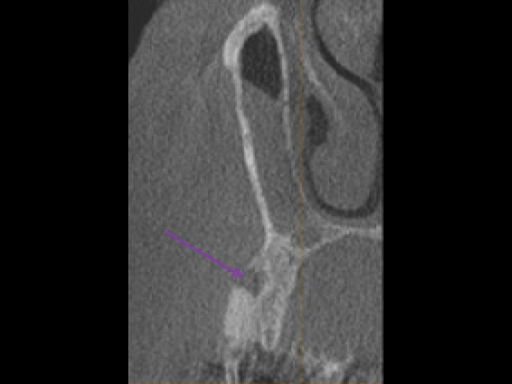 CBCT Scan fenestration