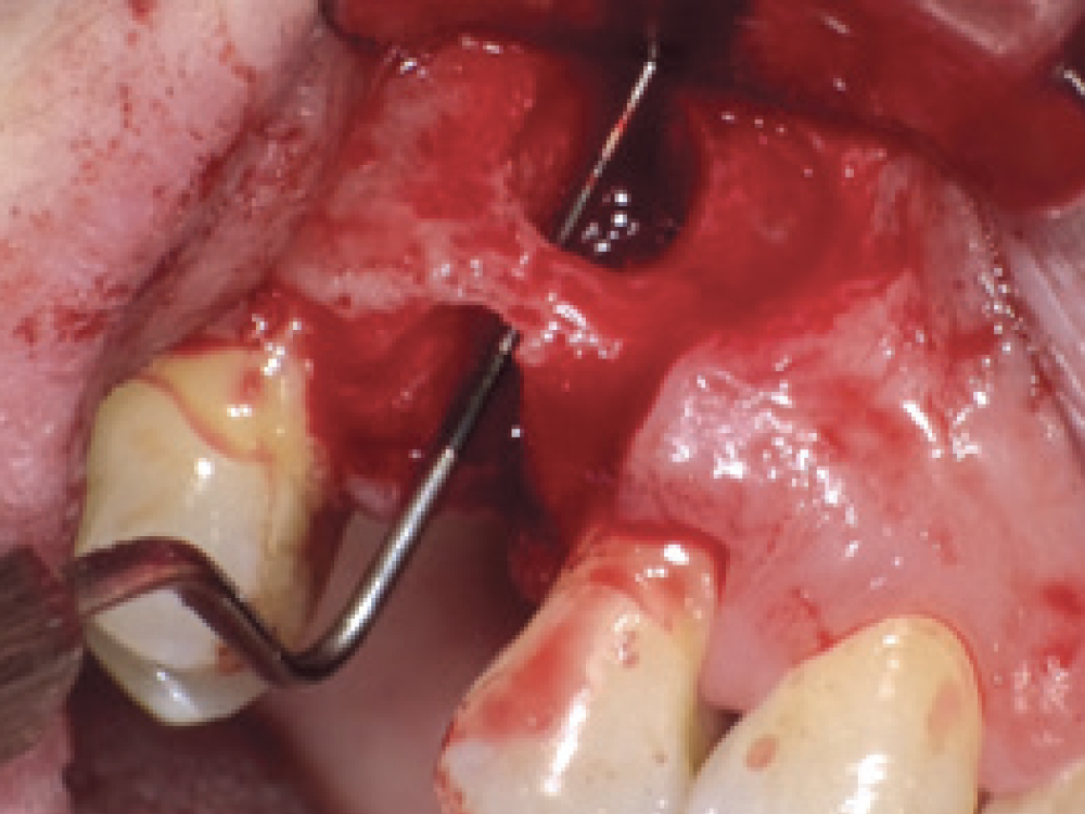 Premolar extraction of fenestration
