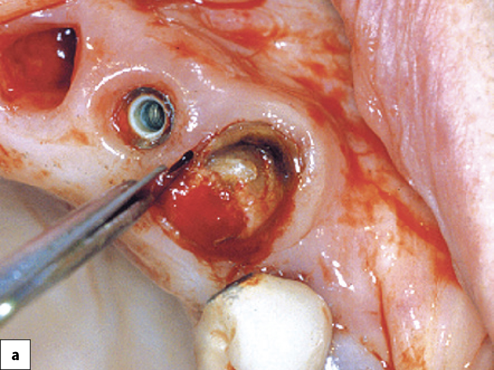 Technique A Severed Periodontal Ligament