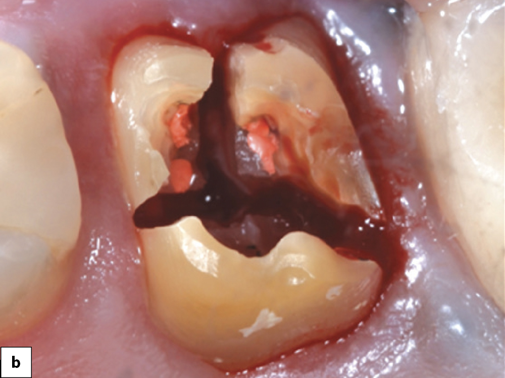 Technique B Multi-rooted Tooth