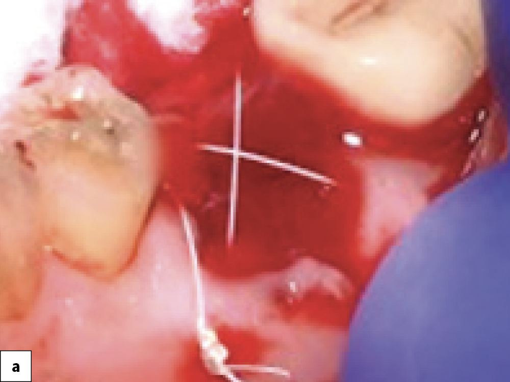 Two-stage Technique Cover Screw Connection