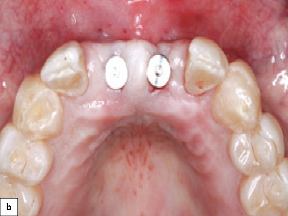 One-stage Technique Abutment Placed